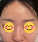 ニードルRF（ポテンツァなど） エトワールレジーナクリニック新宿院 DAY 6 サムネイル用