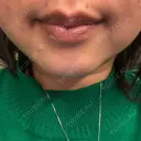 ピコスポット APスキンクリニック銀座 AFTER サムネイル用