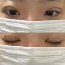 二重埋没 湘南美容クリニック 千葉センシティ院 DAY 5 サムネイル用