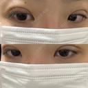 二重埋没 湘南美容クリニック 千葉センシティ院 DAY 5 サムネイル用