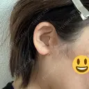 切開リフト GRACY TOKYO CLINIC【グレイシートウキョウクリニック】 DAY 10 サムネイル用