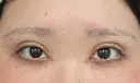 二重埋没 / 目頭切開 アリエル美容クリニック 大宮院 DAY 36 サムネイル用