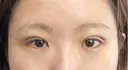 二重埋没 アリエル美容クリニック 郡山院 DAY 5 サムネイル用
