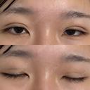 二重埋没 湘南美容クリニック 千葉センシティ院 DAY 1 サムネイル用
