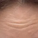 ボトックス（あご） / ボトックス（口角） / ボトックス（肩） / ボトックス（眉間） / ボトックス（額） / ボトックス（バニーライン） BIZENNクリニック【ビゼンクリニック】 DAY 0 サムネイル用