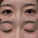 二重埋没 / 自然癒着法 シンデレラ＆ダヴィンチクリニック AFTER サムネイル用