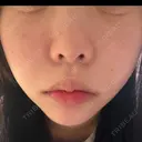 糸リフト / クマ治療 / 脂肪吸引（顔） / 下まぶたたるみ取り / 下まぶたの脂肪取り / ジョールファット除去 / 脂肪注入（目の下） / 脂肪吸引注射（顔） / ヒアルロン酸注入（あご） / ボトックス（エラ・小顔） SEA CLINIC（シークリニック） DAY 36 サムネイル用