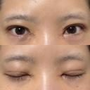二重埋没 / 目頭切開 / 上まぶたの脂肪取り / ヒアルロン酸注入（涙袋） アリエル美容クリニック 郡山院 DAY 21 サムネイル用