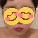 二重埋没 / 脂肪吸引（顔） ルラ美容クリニック 名古屋本院 AFTER サムネイル用