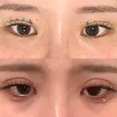 二重埋没 / 脂肪吸引（顔） ルラ美容クリニック 名古屋本院 DAY 13 サムネイル用