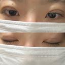 二重埋没 湘南美容クリニック 千葉センシティ院 DAY 7 サムネイル用