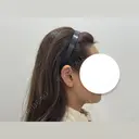脂肪吸引（顔） HAAB BEAUTY CLINIC 南青山本院（新院） DAY 28 サムネイル用