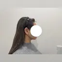 脂肪吸引（顔） HAAB BEAUTY CLINIC 南青山本院（新院） DAY 90 サムネイル用