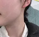 オンダリフト HAAB CLINIC 池袋院 DAY 0 サムネイル用