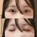 二重埋没 アリエル美容クリニック 横浜院 DAY 0 サムネイル用