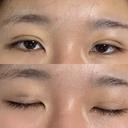 二重埋没 湘南美容クリニック 千葉センシティ院 DAY 2 サムネイル用
