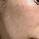 ルメッカ やさしい美容皮膚科・皮フ科　東京浅草院 DAY 11 サムネイル用