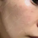 ルメッカ やさしい美容皮膚科・皮フ科　東京浅草院 AFTER サムネイル用