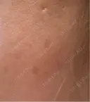 ピーリング（ハリ・ツヤ） / ルメッカ 小倉美容外科/美容皮膚科 ビラビューティークリニック AFTER サムネイル用