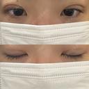 二重埋没 湘南美容クリニック 千葉センシティ院 DAY 8 サムネイル用