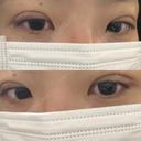 二重埋没 湘南美容クリニック 千葉センシティ院 DAY 8 サムネイル用