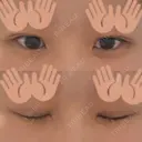 二重埋没 ルラ美容クリニック 渋谷本院 DAY 9 サムネイル用