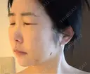 糸リフト / クマ治療 / バッカルファット除去 / 脂肪吸引（顔） / ジョールファット除去 / ネックリフト BLINC CLINIC （ブリンク クリニック） DAY 8 サムネイル用
