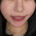 糸リフト / クマ治療 / 脂肪吸引（顔） / 下まぶたたるみ取り / 下まぶたの脂肪取り / ジョールファット除去 / 脂肪注入（目の下） / 脂肪吸引注射（顔） / ヒアルロン酸注入（あご） / ボトックス（エラ・小顔） SEA CLINIC（シークリニック） DAY 38 サムネイル用