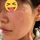 肌育注射（ジュベルックなど） メディアージュクリニック 大阪梅田院 DAY 0 サムネイル用