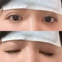 二重埋没 アリエル美容クリニック 横浜院 DAY 1 サムネイル用