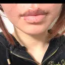 シミ取りレーザー 新宿美容外科クリニック 新宿院 DAY 0 サムネイル用