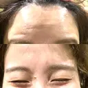 ボトックス（あご） / ボトックス（目尻） / ボトックス（額） 湘南美容クリニック 千葉センシティ院 DAY 1 サムネイル用