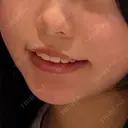 糸リフト / クマ治療 / 脂肪吸引（顔） / 下まぶたたるみ取り / 下まぶたの脂肪取り / ジョールファット除去 / 脂肪注入（目の下） / 脂肪吸引注射（顔） / ヒアルロン酸注入（あご） / ボトックス（エラ・小顔） SEA CLINIC（シークリニック） DAY 38 サムネイル用