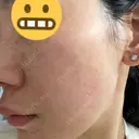肌育注射（ジュベルックなど） メディアージュクリニック 大阪梅田院 DAY 3 サムネイル用