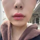 ヒアルロン酸注入（唇） Wing clinic 豊中駅前院 DAY 2 サムネイル用