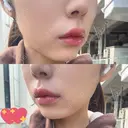 ヒアルロン酸注入（唇） Wing clinic 豊中駅前院 DAY 2 サムネイル用