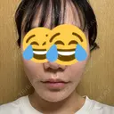 糸リフト BON BON CLINIC 銀座駅前本院 DAY 1 サムネイル用