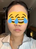 糸リフト BON BON CLINIC 銀座駅前本院 DAY 4 サムネイル用