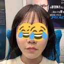 糸リフト BON BON CLINIC 銀座駅前本院 DAY 6 サムネイル用