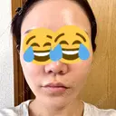 糸リフト BON BON CLINIC 銀座駅前本院 AFTER サムネイル用