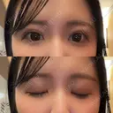 二重埋没 アリエル美容クリニック 横浜院 DAY 3 サムネイル用