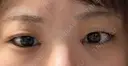 目頭切開 Stand by Beauty Clinic DAY 0 サムネイル用
