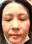 スネコス けやき美容クリニック 沼津院 DAY 8 サムネイル用