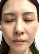 スネコス けやき美容クリニック 沼津院 DAY 9 サムネイル用