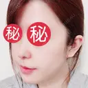 鼻中隔延長（切開） / 骨切り（あご） / 骨削り（エラ） / 軟骨移植 / 眉間プロテーゼ id（アイディ）美容外科 DAY 15 サムネイル用