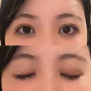二重埋没 アリエル美容クリニック 横浜院 DAY 4 サムネイル用