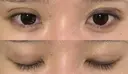 二重埋没 / ヒアルロン酸注入（涙袋） アリエル美容クリニック 大宮院 DAY 5 サムネイル用