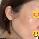 切開リフト GRACY TOKYO CLINIC【グレイシートウキョウクリニック】 DAY 16 サムネイル用