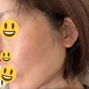 切開リフト GRACY TOKYO CLINIC【グレイシートウキョウクリニック】 DAY 16 サムネイル用