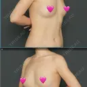 脂肪吸引（二の腕） / 脂肪吸引（脚） / 豊胸（脂肪注入） Lipo Clinic omotesando AFTER サムネイル用